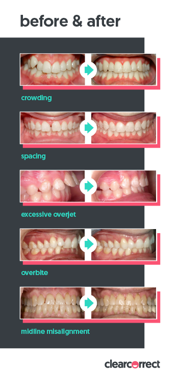 Clear Correct Aligners Patient Before and Afters - McOmie Family